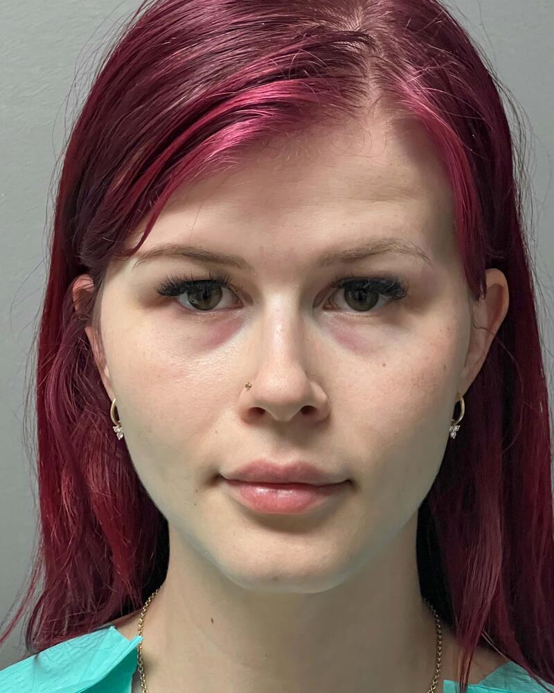 Blepharoplasty Before & After Image