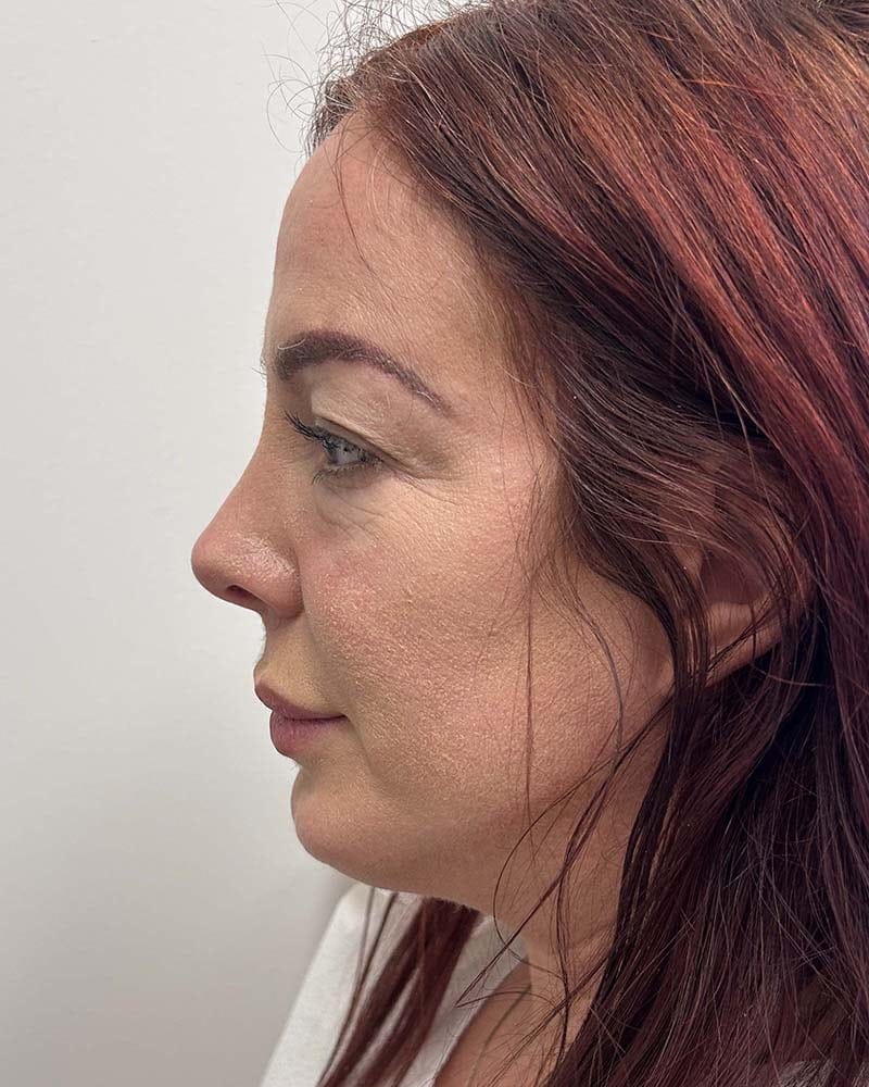 Blepharoplasty Before & After Image