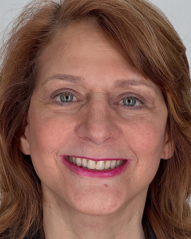 Blepharoplasty Before & After Image