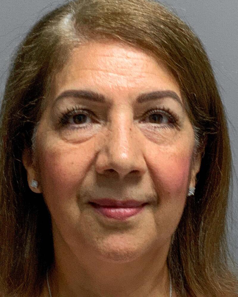 Blepharoplasty Before & After Image