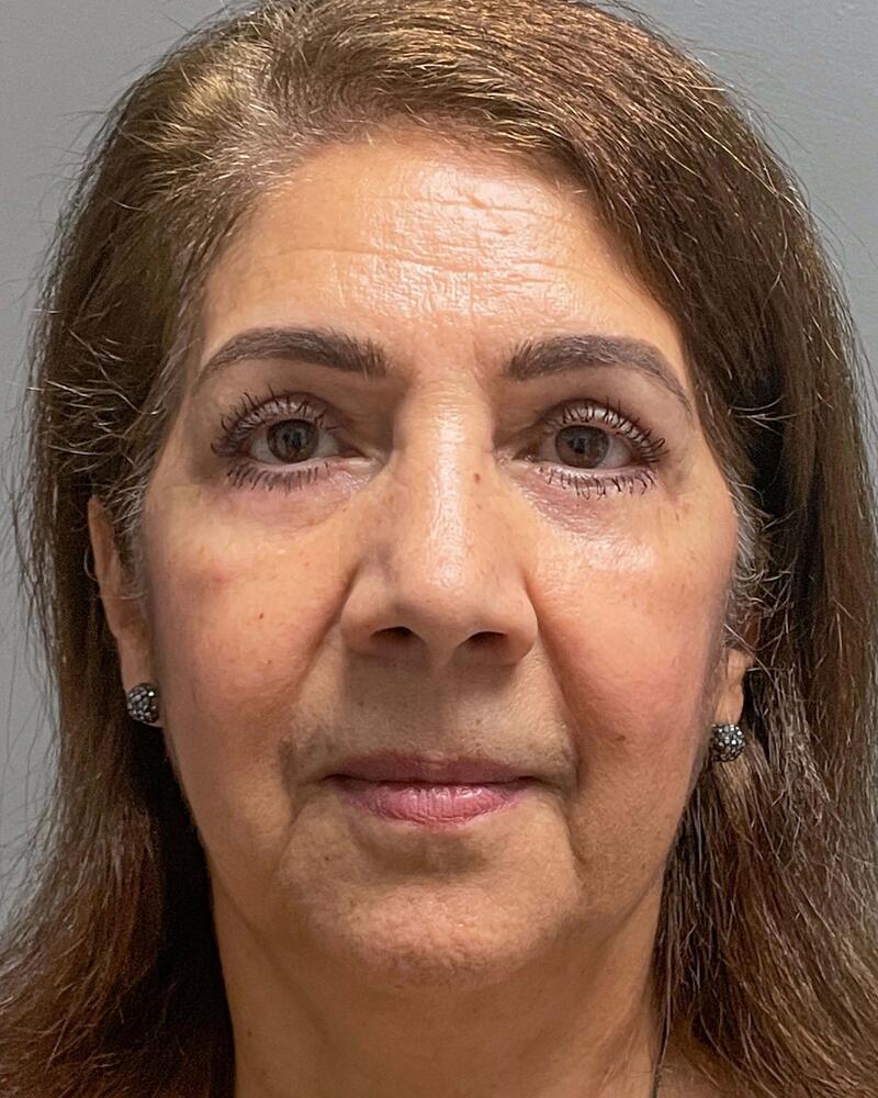Blepharoplasty Before & After Image