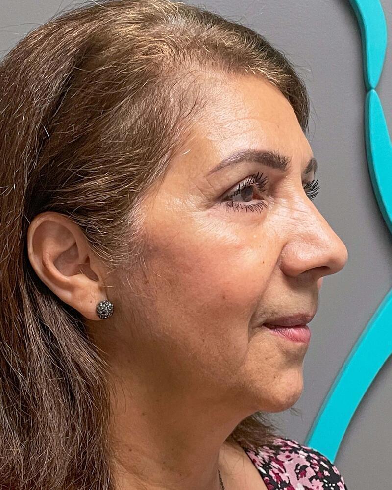Blepharoplasty Before & After Image