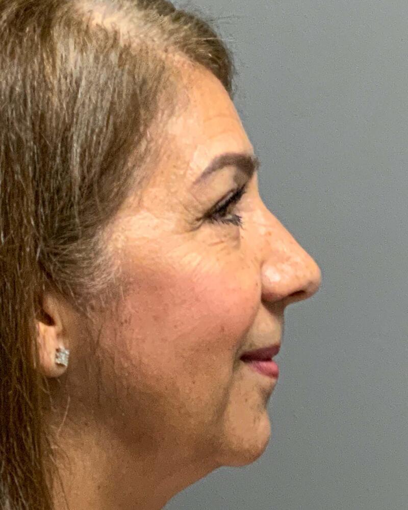 Blepharoplasty Before & After Image