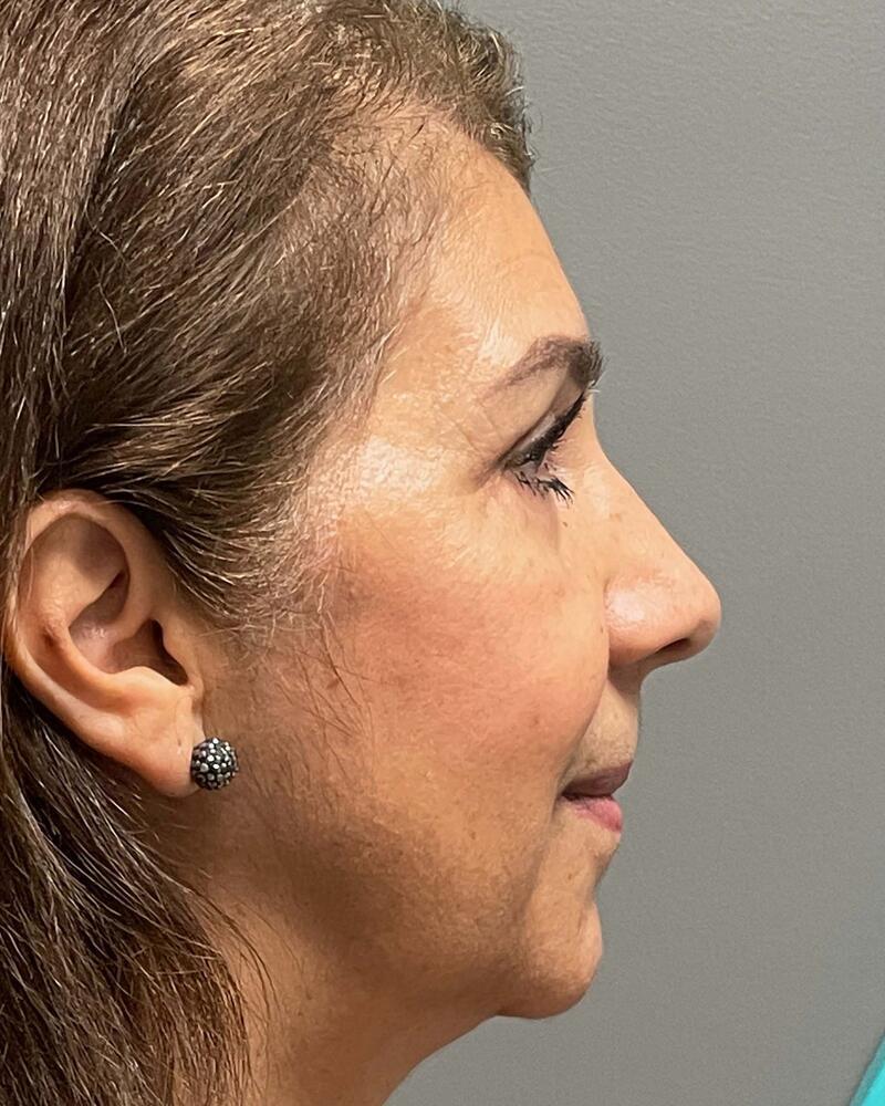 Blepharoplasty Before & After Image