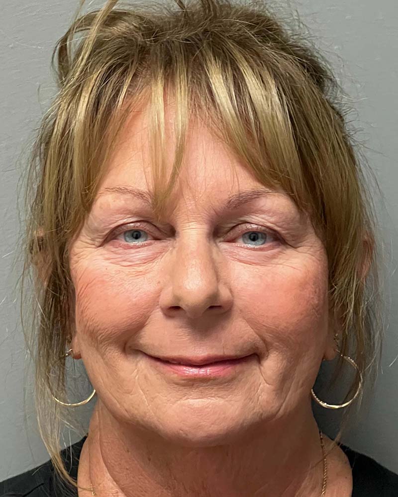 Blepharoplasty Before & After Image