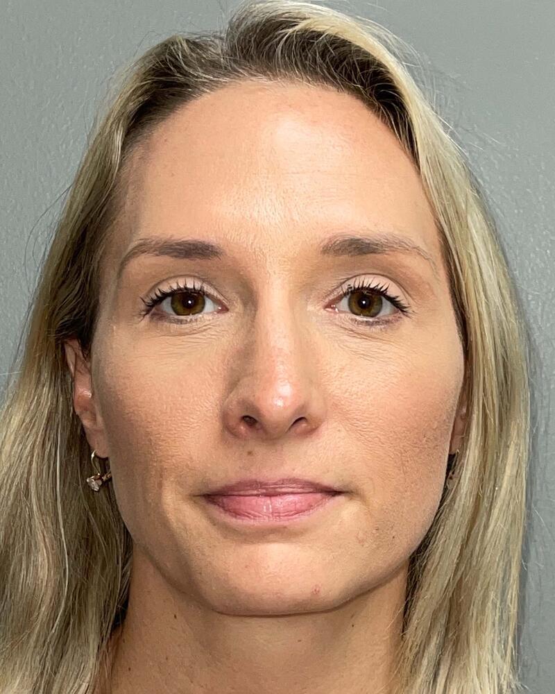 Blepharoplasty Before & After Image