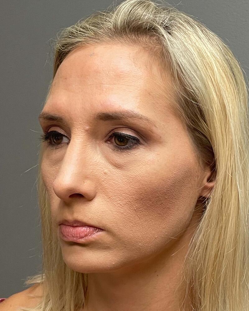 Blepharoplasty Before & After Image