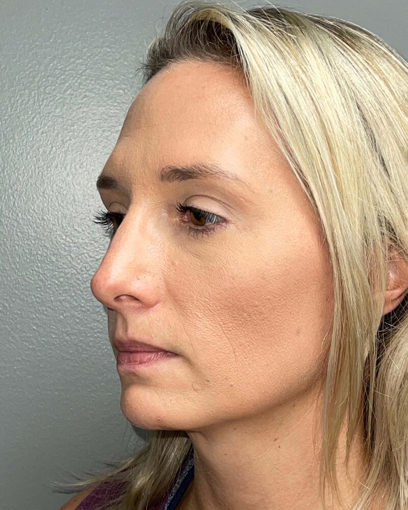 Blepharoplasty Before & After Image