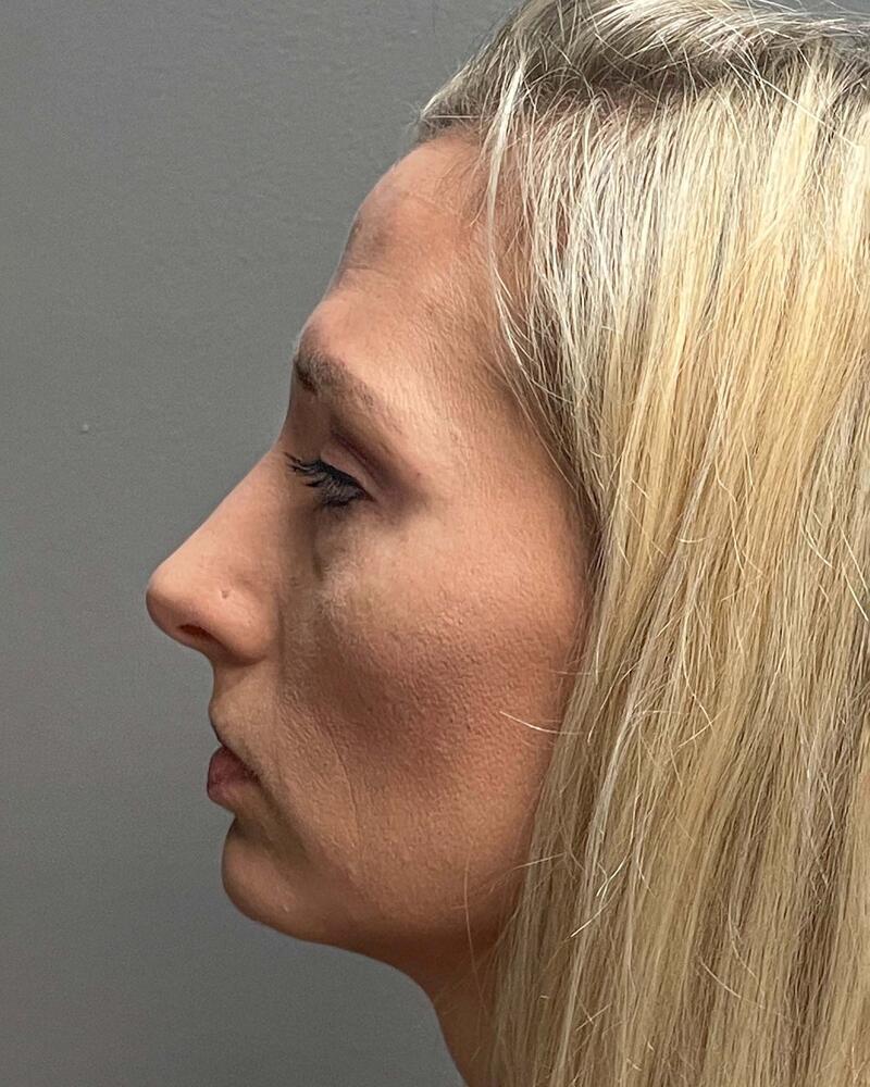 Blepharoplasty Before & After Image