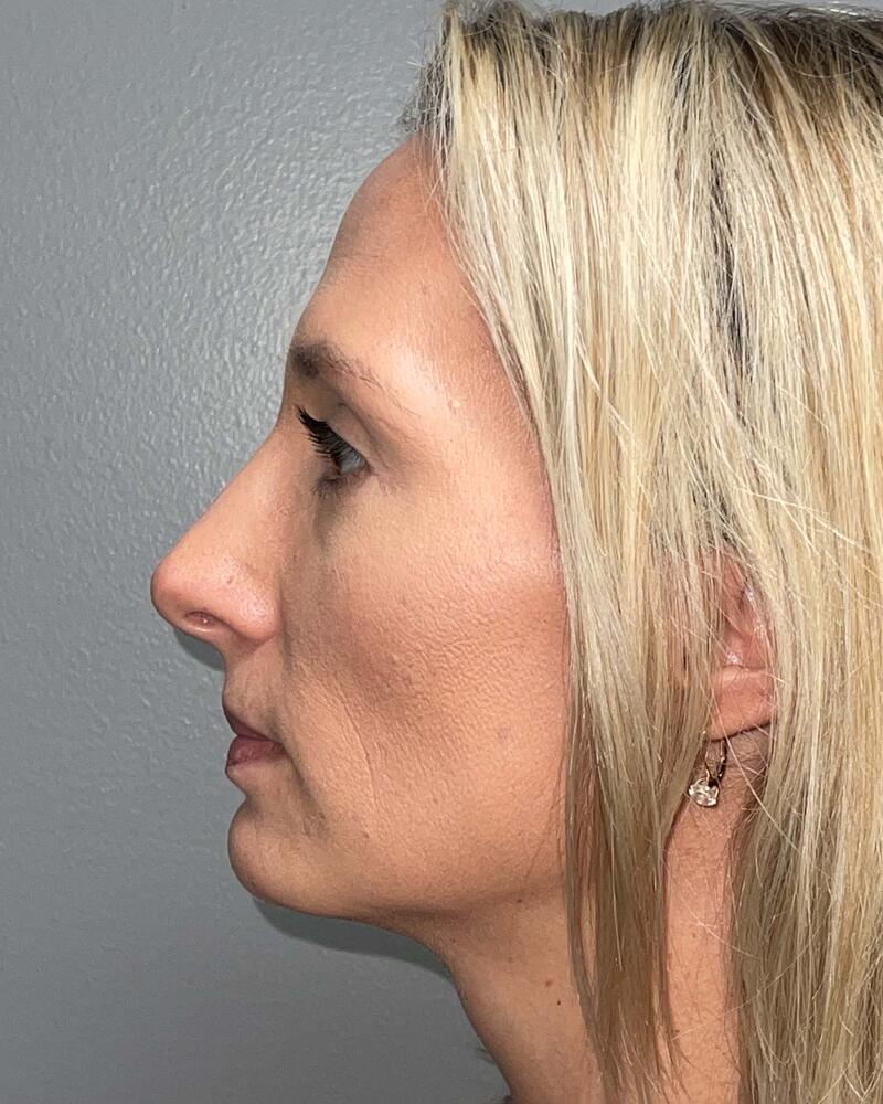 Blepharoplasty Before & After Image