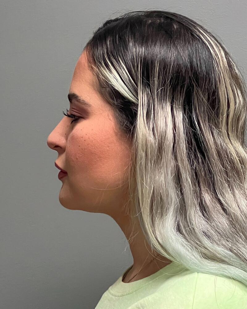 Buccal Fat Removal Before & After Image
