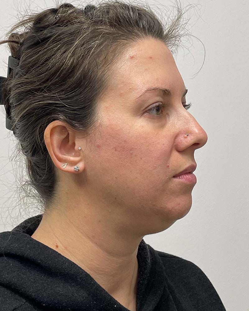 Chin Liposuction Before & After Image