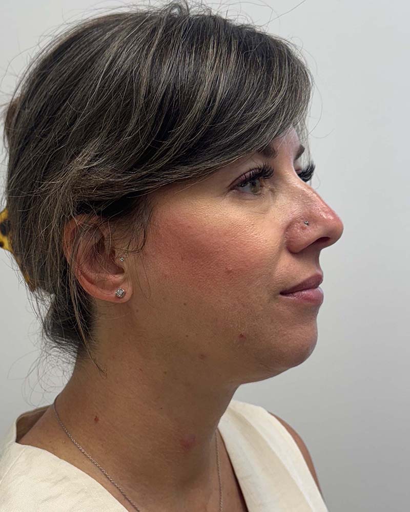 Chin Liposuction Before & After Image