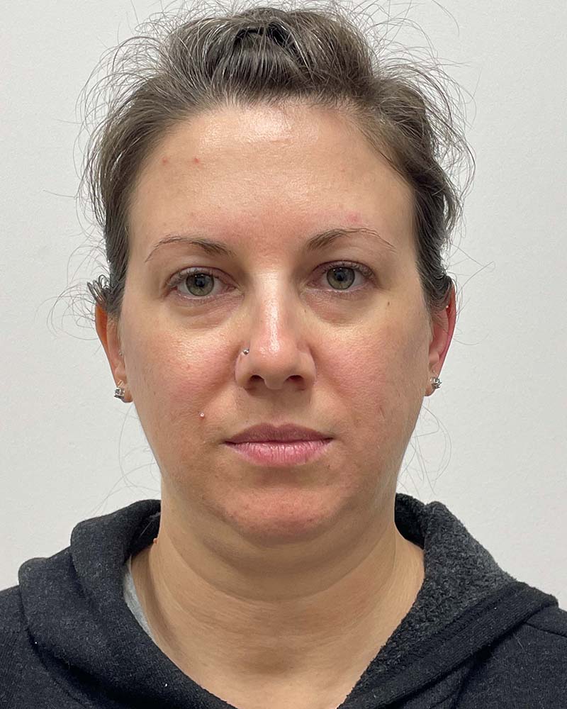 Chin Liposuction Before & After Image