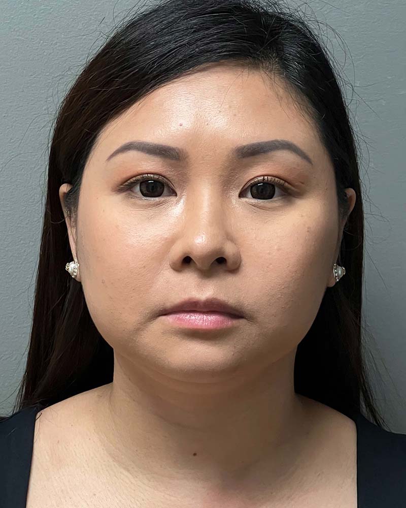 Chin Liposuction Before & After Image