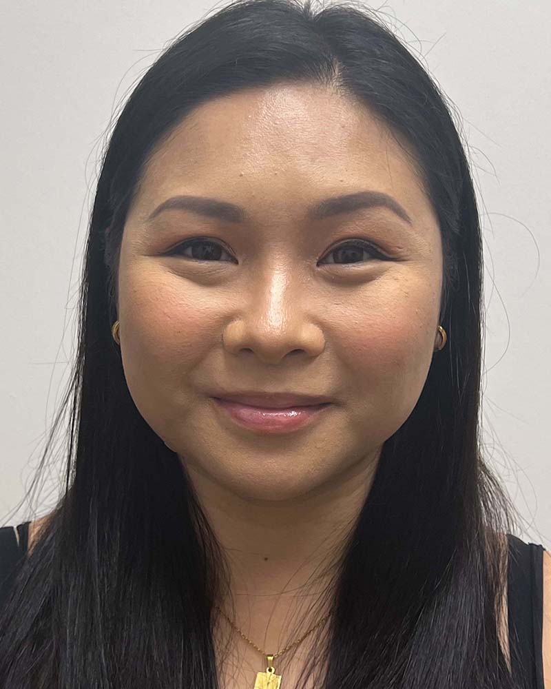 Chin Liposuction Before & After Image