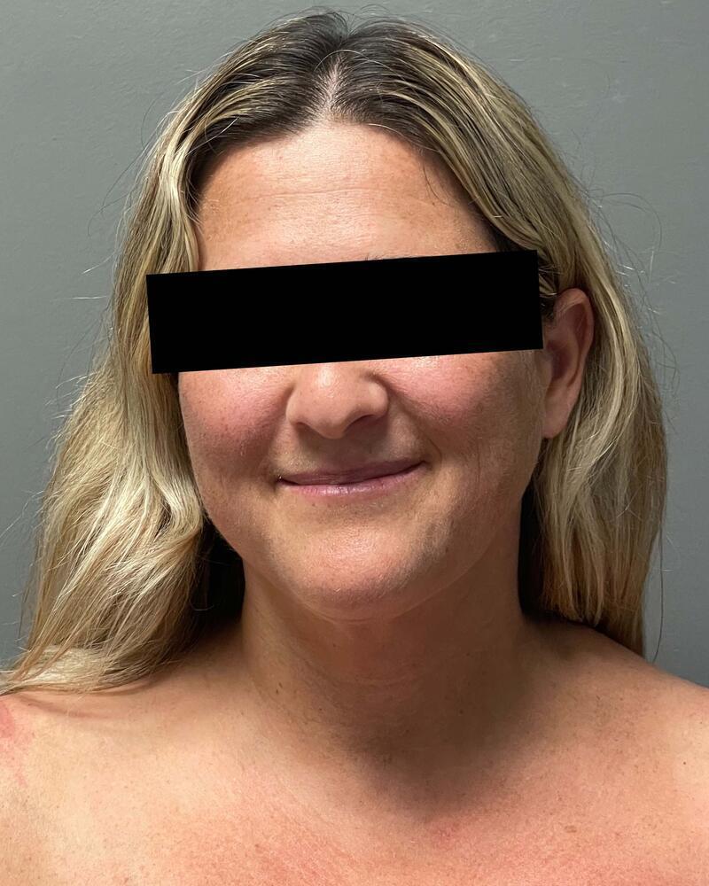 Chin Liposuction Before & After Image