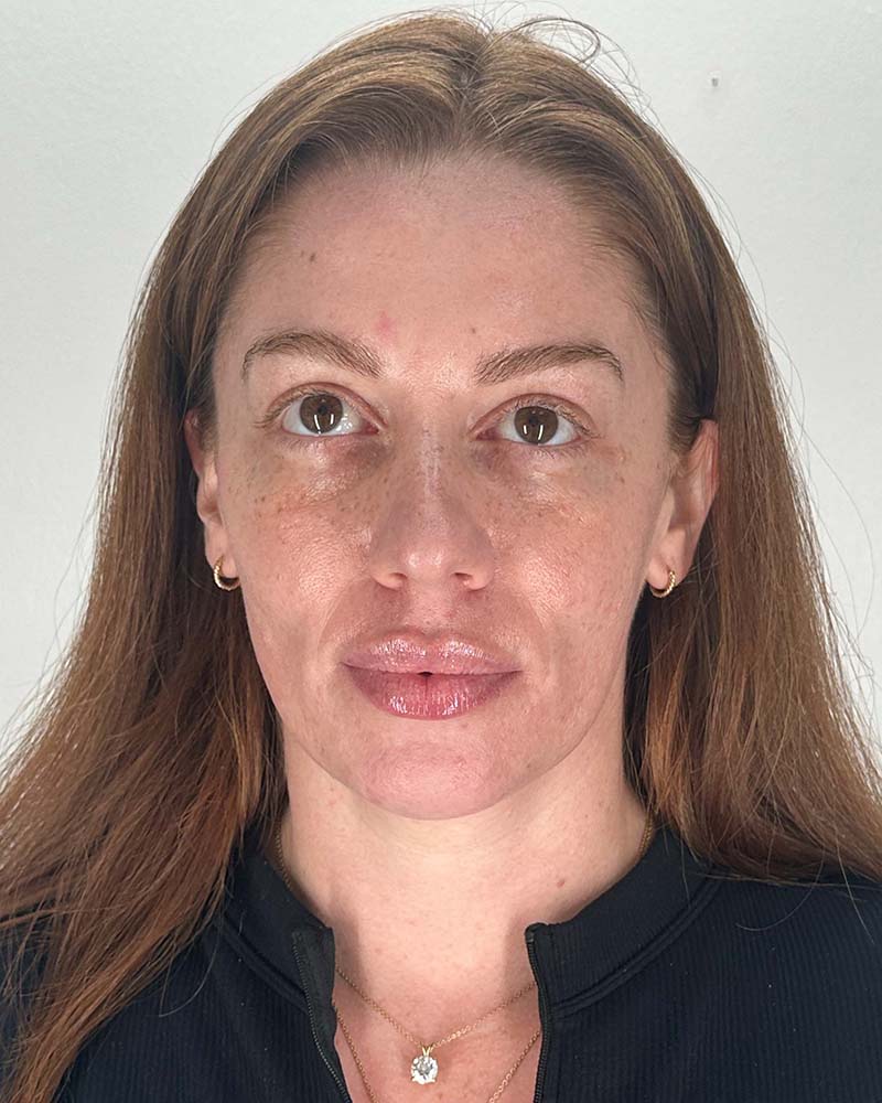 Chin Liposuction Before & After Image