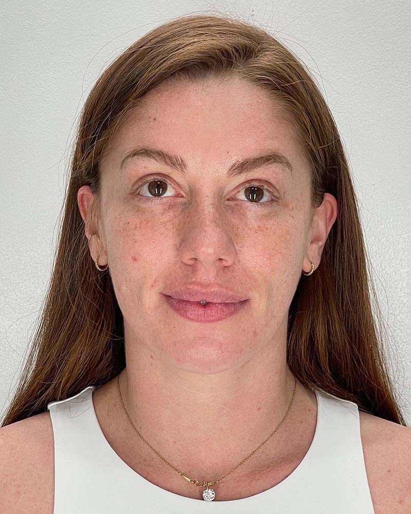 Chin Liposuction Before & After Image