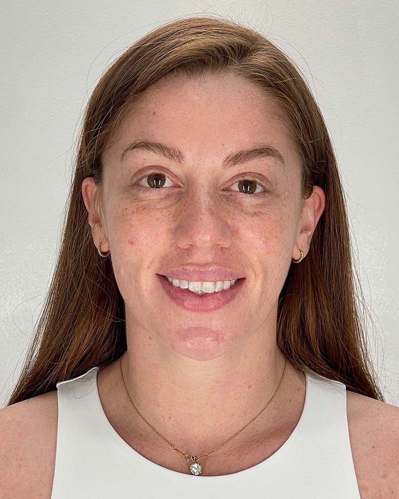 Chin Liposuction Before & After Image