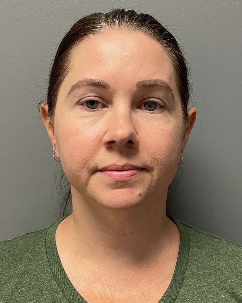 Chin Liposuction Before & After Image
