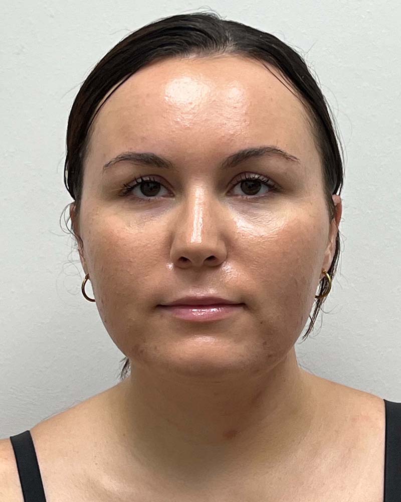 Chin Liposuction Before & After Image