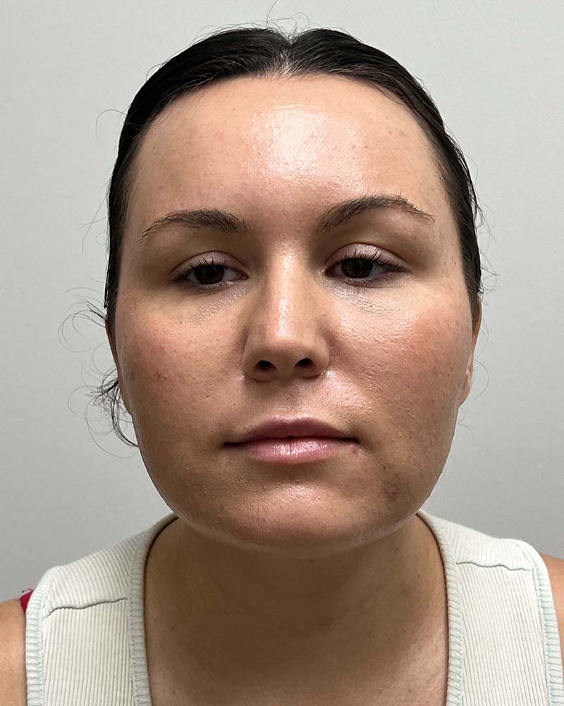 Chin Liposuction Before & After Image