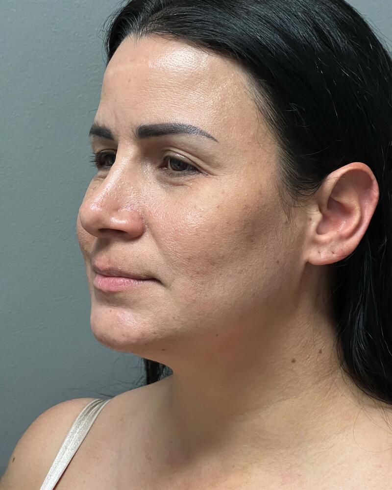 Chin Liposuction Before & After Image