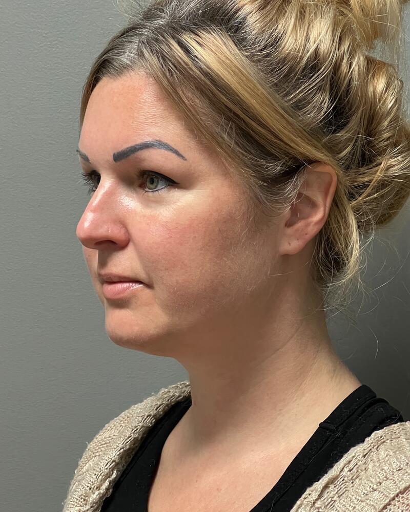 Chin Liposuction Before & After Image