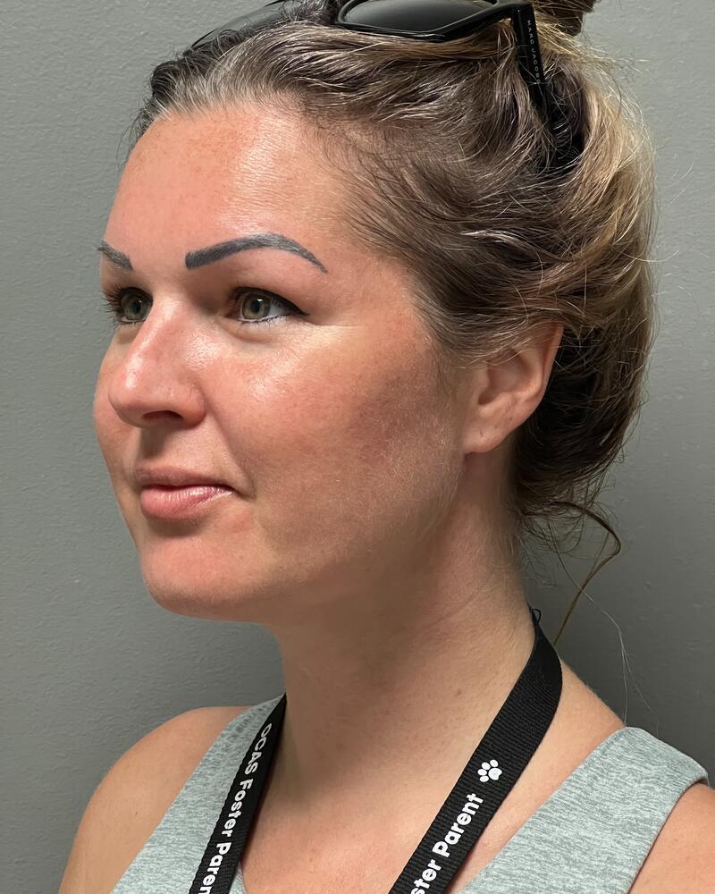 Chin Liposuction Before & After Image