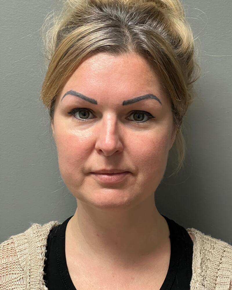 Chin Liposuction Before & After Image