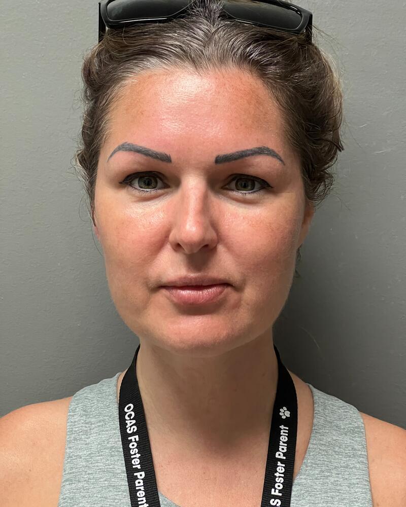 Chin Liposuction Before & After Image