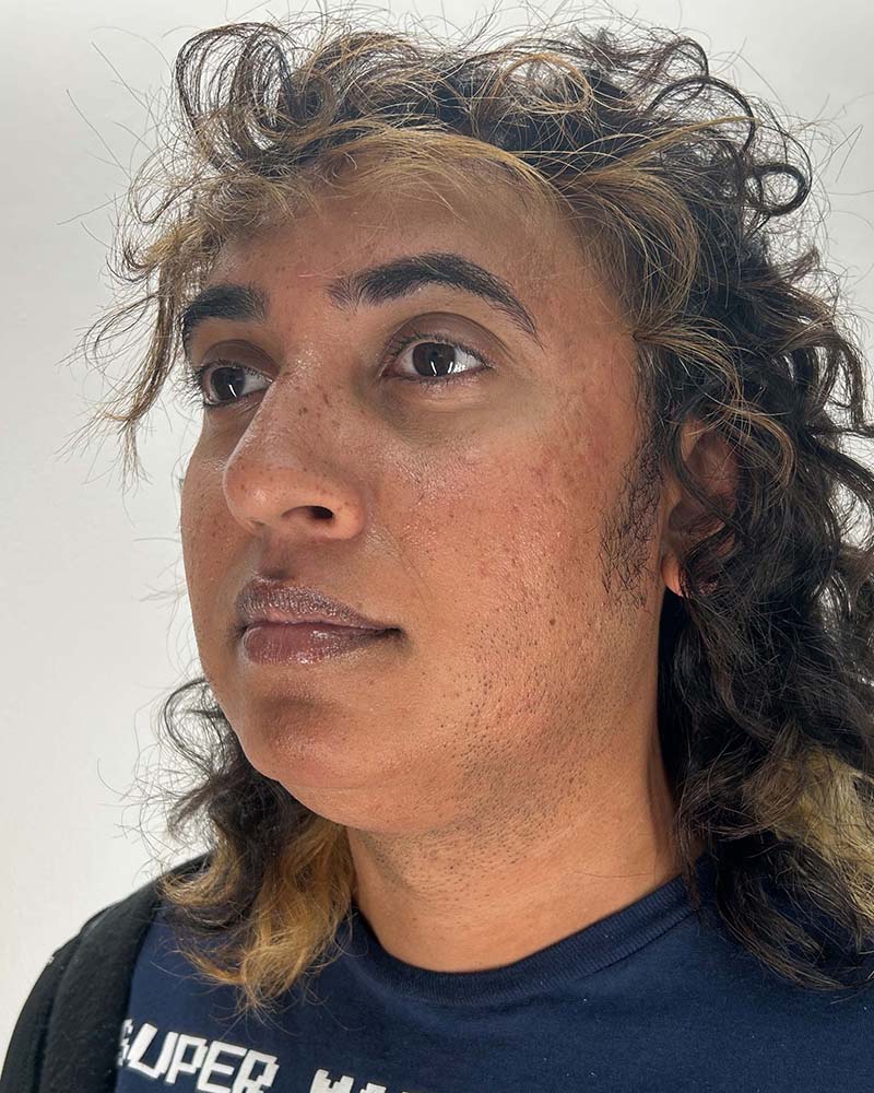 Chin Liposuction Before & After Image