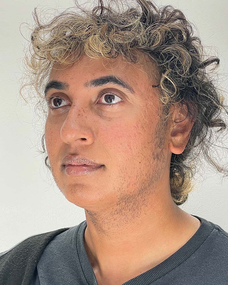 Chin Liposuction Before & After Image