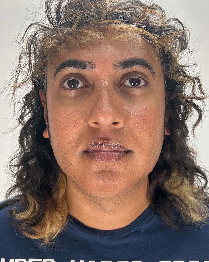 Chin Liposuction Before & After Image