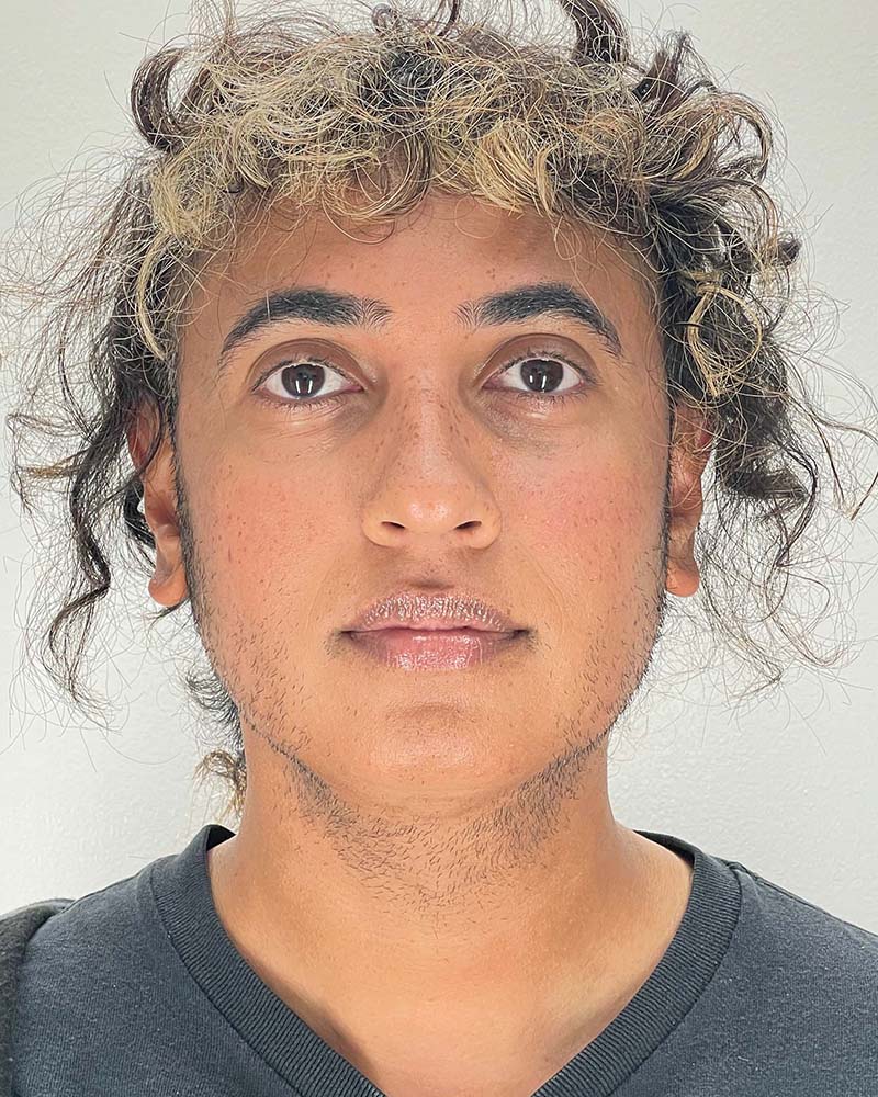 Chin Liposuction Before & After Image