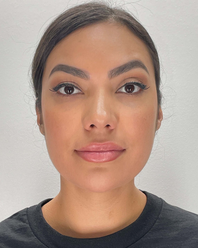 Chin Liposuction Before & After Image