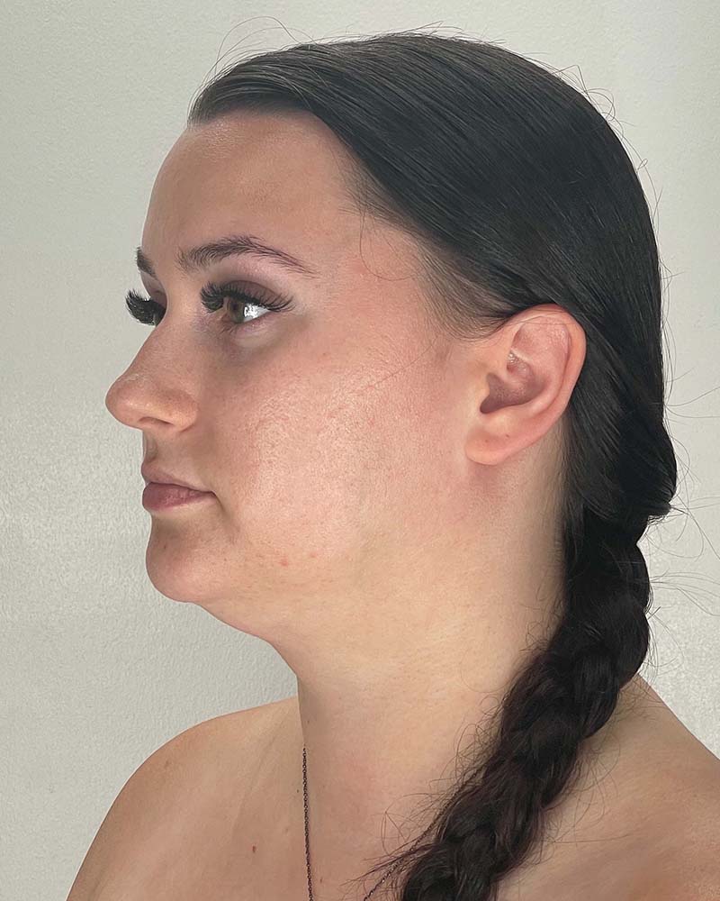 Chin Liposuction Before & After Image