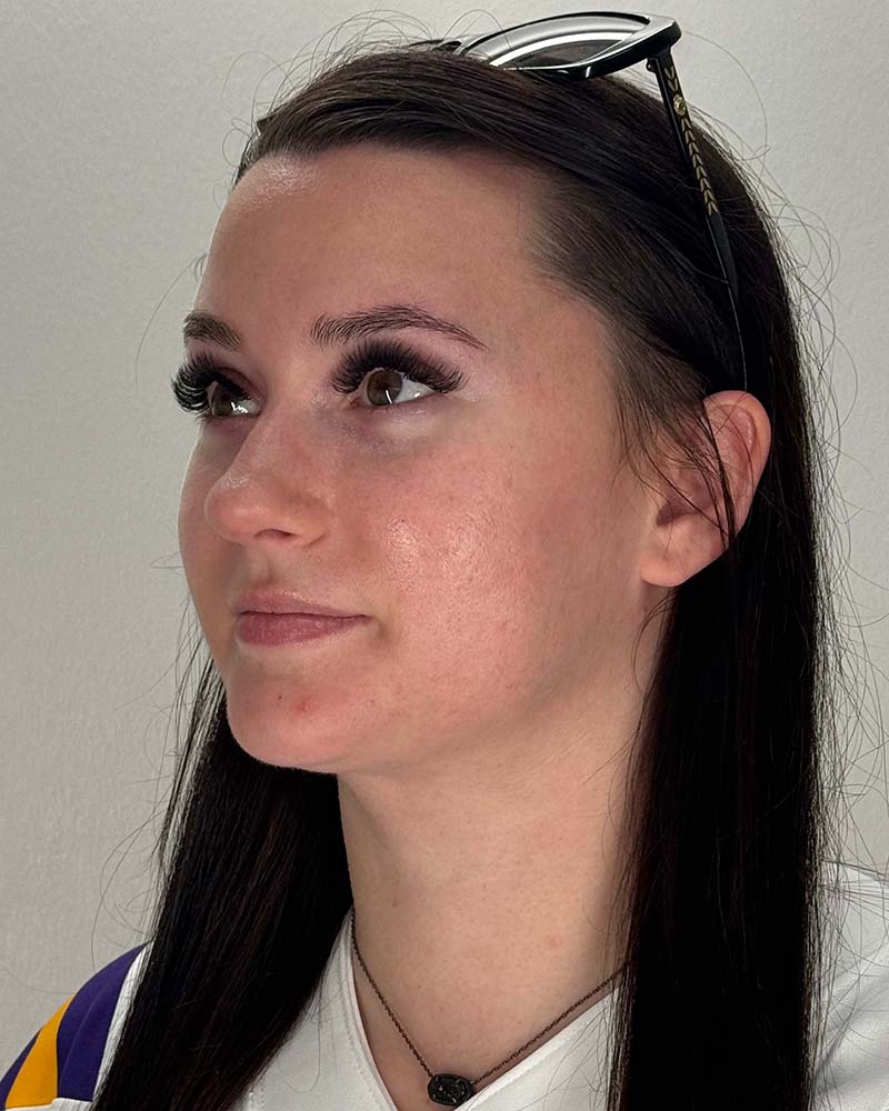 Chin Liposuction Before & After Image