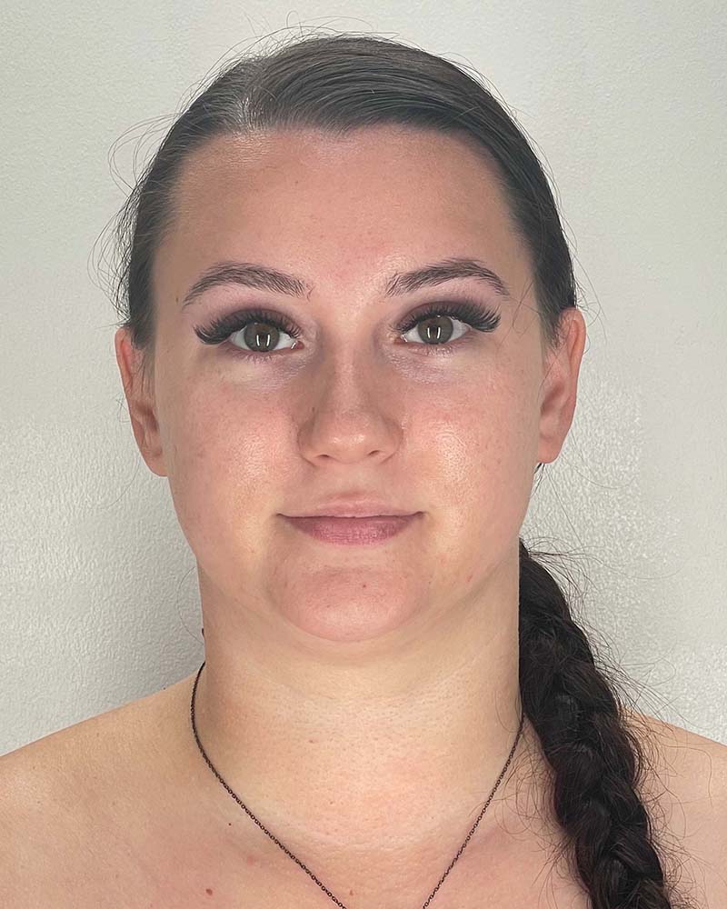 Chin Liposuction Before & After Image