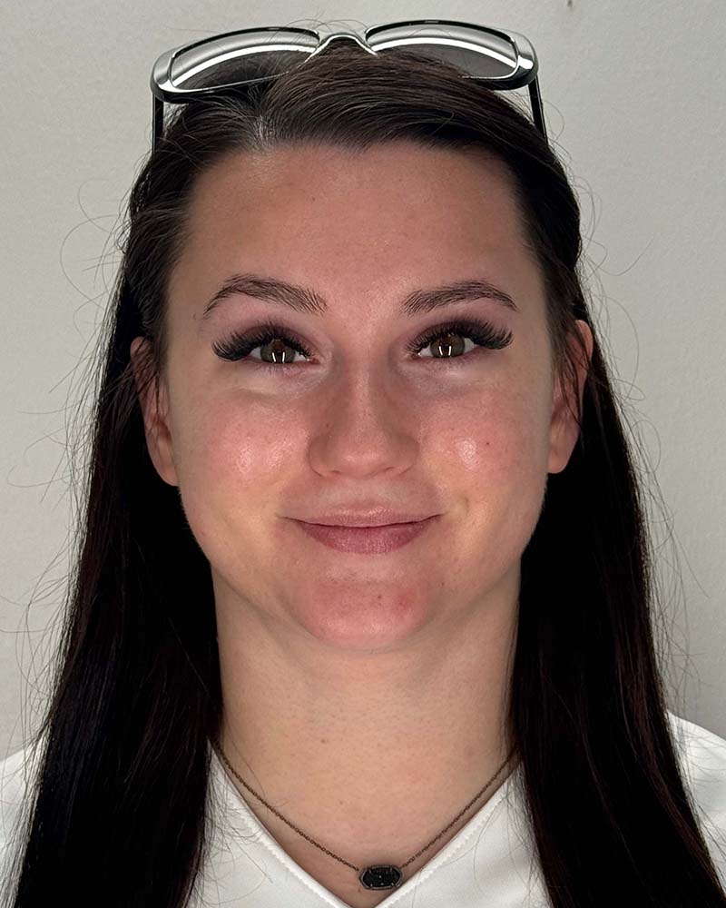 Chin Liposuction Before & After Image