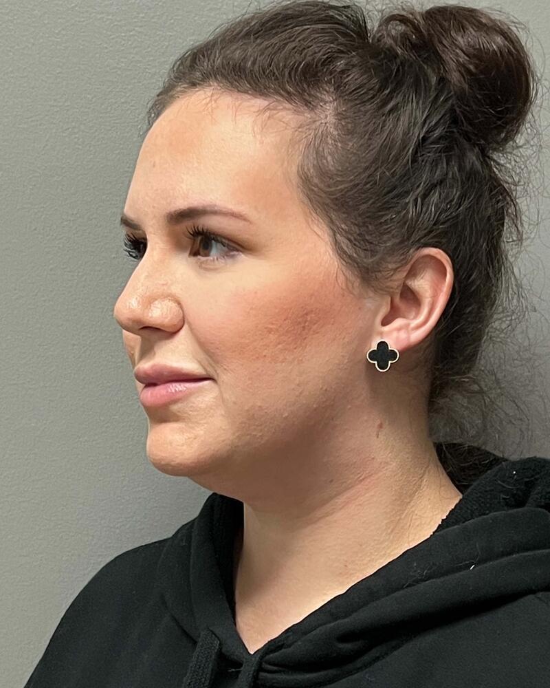 Chin Liposuction Before & After Image