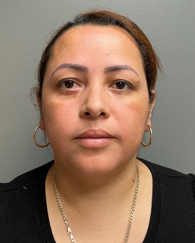 Chin Liposuction Before & After Image