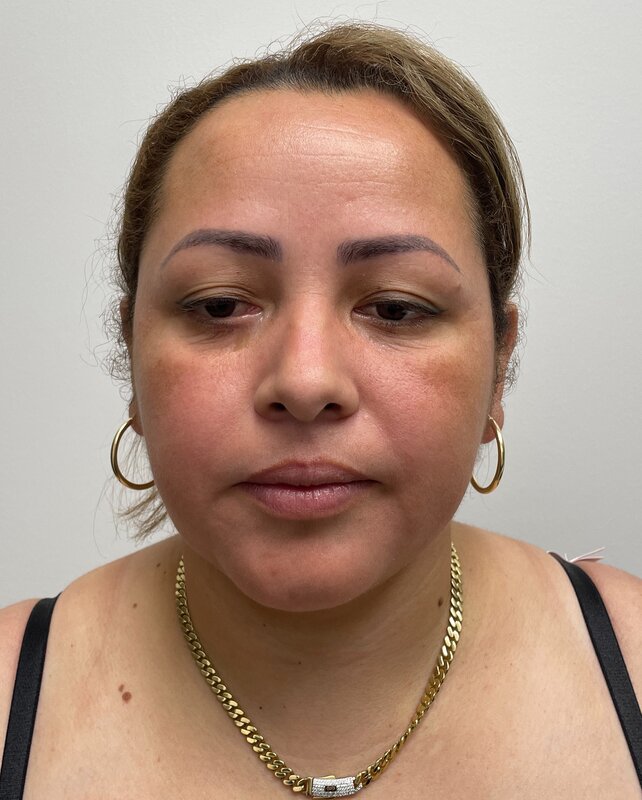 Chin Liposuction Before & After Image