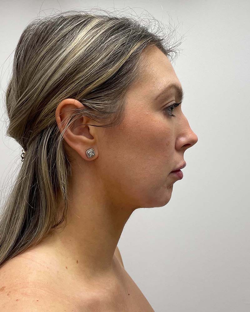 Chin Liposuction Before & After Image