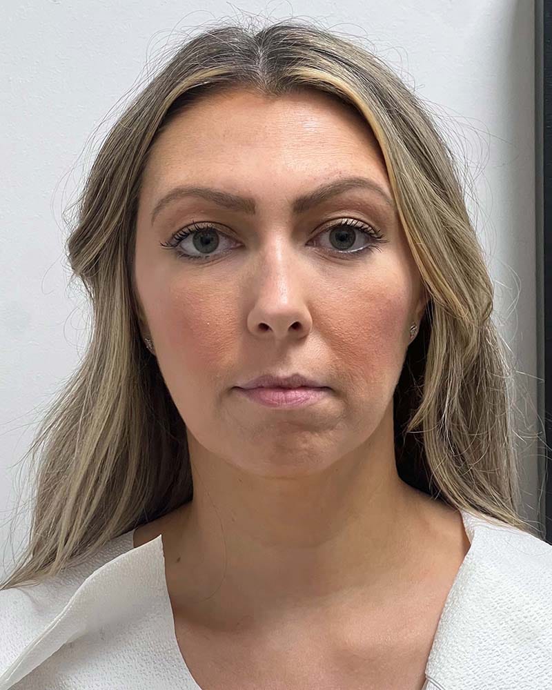 Chin Liposuction Before & After Image