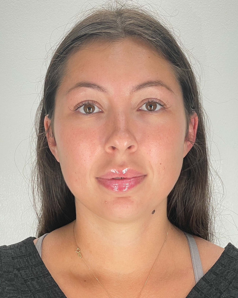 Chin Liposuction Before & After Image