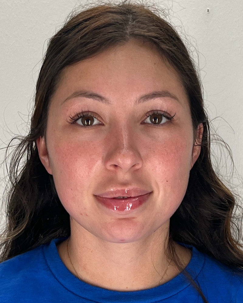 Chin Liposuction Before & After Image