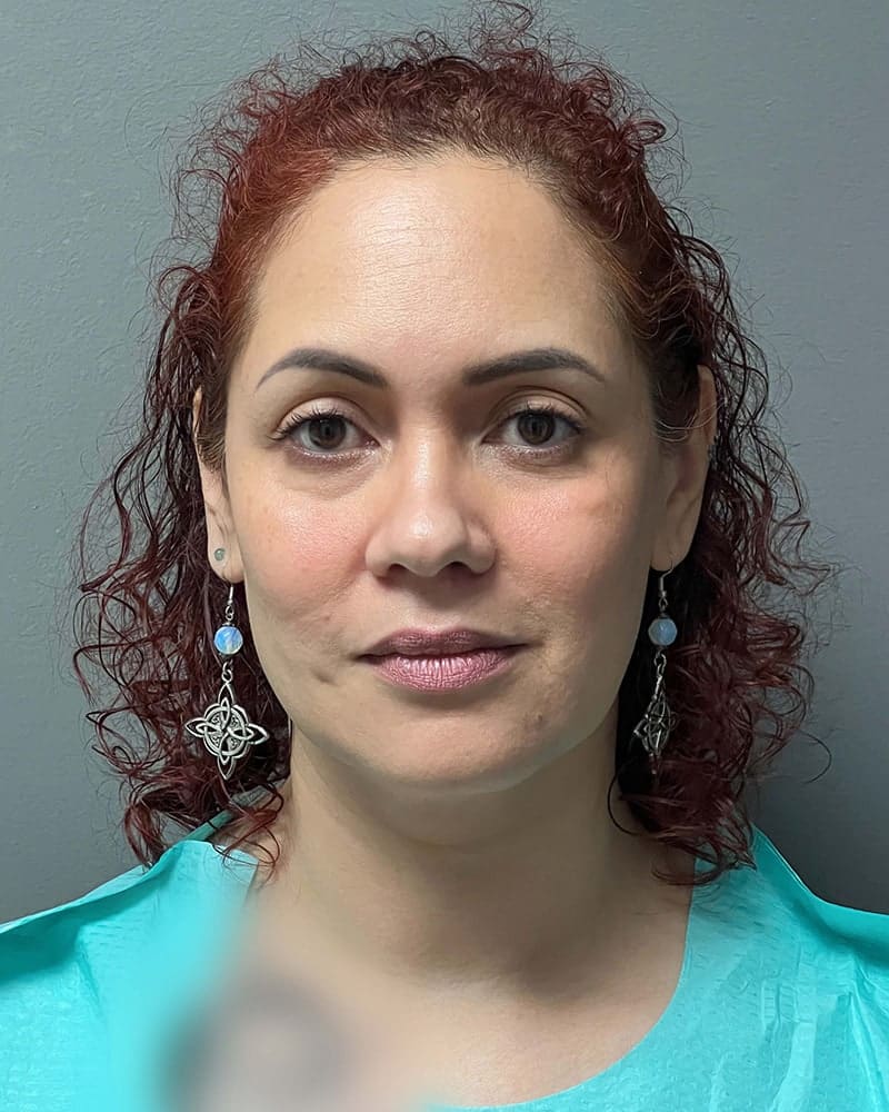 Chin Liposuction Before & After Image