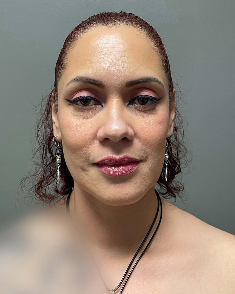 Chin Liposuction Before & After Image